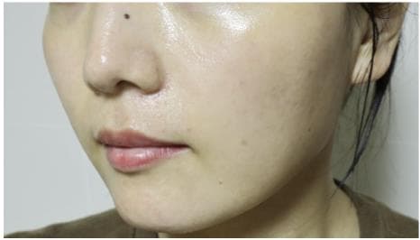 LIV Plastic Surgery — Case #17 — After
