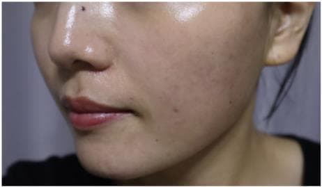 LIV Plastic Surgery — Case #17 — Before